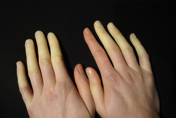 Raynaud’s Disease: Keeping Hands Warm and Comfortable This Winter